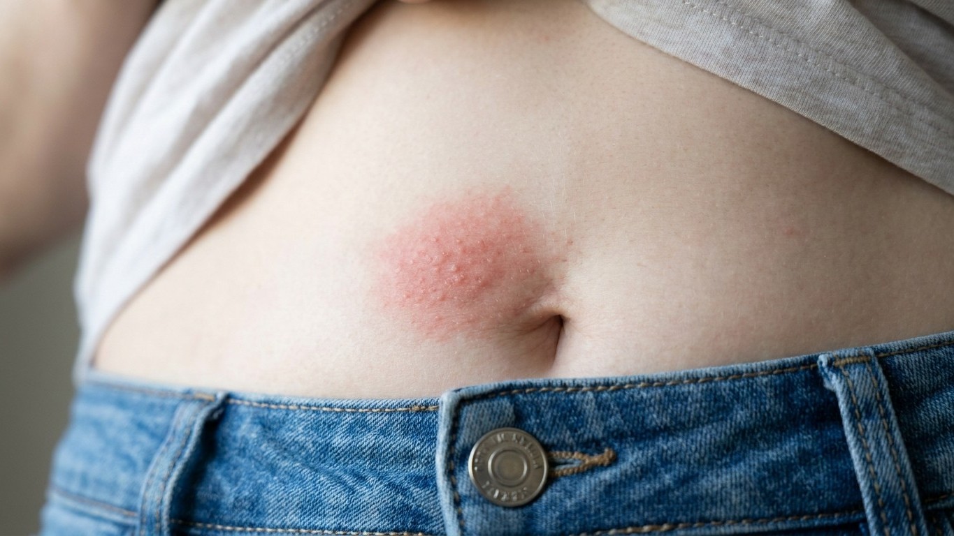 Wir alle schieben den juckenden roten Ring um den Bauchnabel auf das Waschmittel, dabei sitzt die Ursache wenige Zentimete...